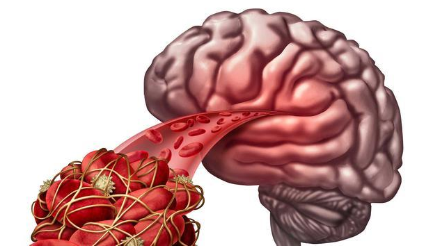 脑溢血和脑出血有什么区别？脑溢血和脑出血的区别
