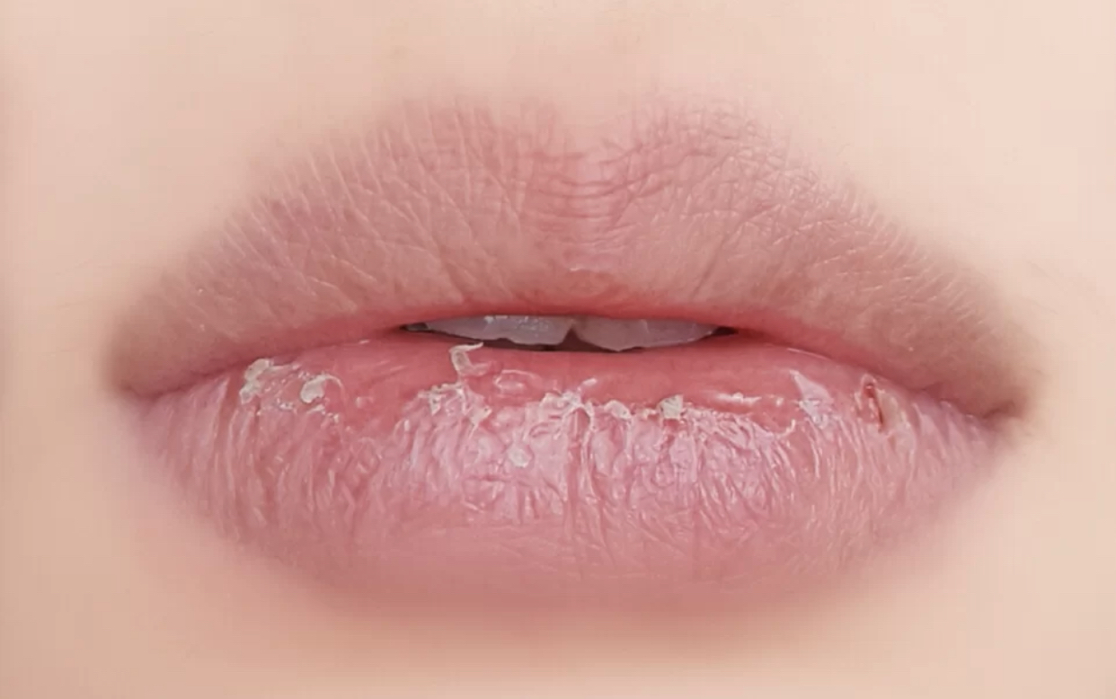 嘴皮干燥是什么原因？嘴皮干燥的原因