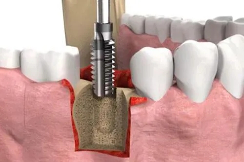 种植牙的过程一般分为几个步骤？种植牙的过程详解